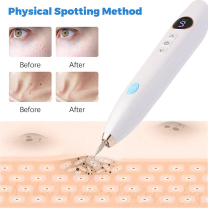 Plasma Pen Skin Tag Remover